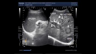 Multiple Hepatic metastases [upl. by Dione]