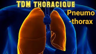 SCANNER THORACIQUE Pneumothorax avec collapsus passif [upl. by Rosse]