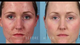 PicoSure Focus Skin Rejuvenation for Treatment of Acne Scars [upl. by Mario]