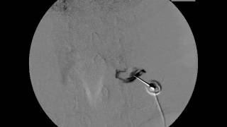 Axial view of C8 selective nerve root block by lateral and prone approaches [upl. by Llemaj]