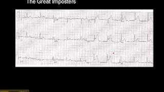 1215 Lead ECG MI Imposter 1 [upl. by Sidoon]