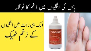 Paon Ki ungliyon mai Zakham ka ilaj  How to Treat wound between Fingers in Urdu amp Hindi [upl. by Anaehs530]