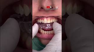 ¡🔥FÉRULA DENTAL de poliuretano🔥 [upl. by Kleper]