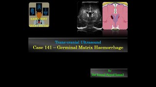 Ultrasound Case 141  Germinal Matrix Haemorrhage [upl. by Healey]