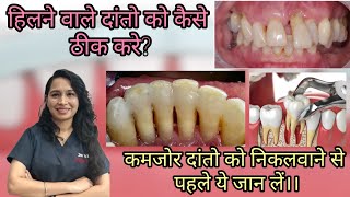 हिलने वाले दांतो का ईलाज।।treatment for teeth mobility splintingdentalpyorrhea periodontitis [upl. by Damle]