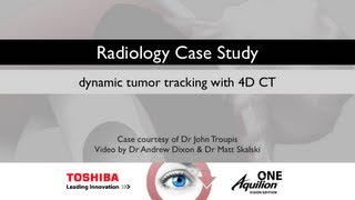 TOSHIBA Aquilion presents 4D CT in Lung Cancer Staging [upl. by Nosbig]