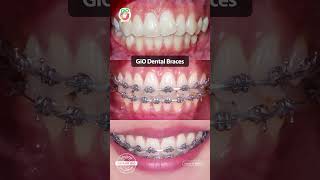 GiO Dental Braces [upl. by Koh]