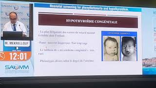 Dépistage néonatale de la phénylcétonurie et de lhypothyroïdie [upl. by Kinson]