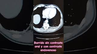 Diferencias de TC de Abdomen con y sin contraste oral y endovenoso tomografia [upl. by Arreic]