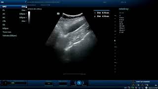 Hydrosalpinx Diagnostic ultrasound cases [upl. by Patrice]