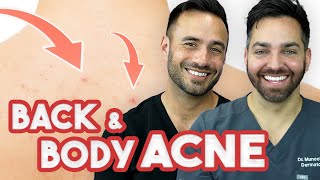 BACK ACNE  How to Treat and Prevent It  Doctorly Routines [upl. by Kciredohr]