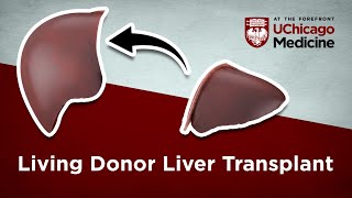 Advances in Liver Transplant Surgery  WebMD [upl. by Nabetse445]