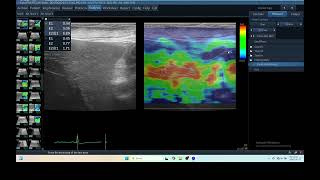 IQ 213 LIVER ELASTOGRAPHY ULTRASOUND [upl. by Chester]