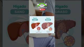 ESTEATOSIS HEPATICA en 1Min salud medicina medico saludable [upl. by Warp480]