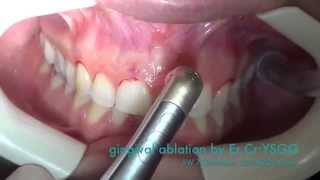 Flapless osseous laser crown lengthening procedure [upl. by Ahsai840]