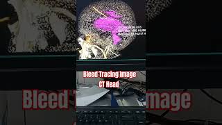 ShortaViral  Bleed Tracing Image  Ct Scan Head  Official Nazim Siddiqui [upl. by Ahcsrop696]