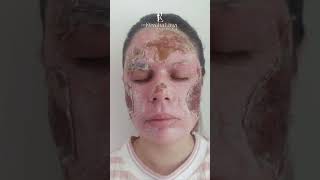 Peeling de Fenol para cicatrizes de acne [upl. by Plusch482]