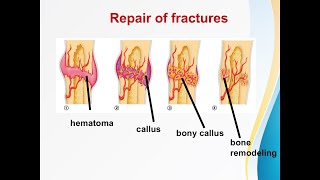 Fracture healing [upl. by Wilber]