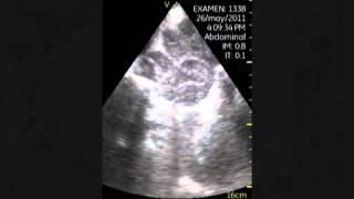 VSCAN Retroperitoneal lymphadenopathy Adenopatías retroperitoneales [upl. by Gaye975]