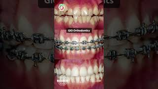 GiO Orthodontics Braces [upl. by Ethelred]