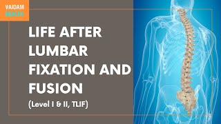 Life After Lumbar Fixation and Fusion Level I amp II TLIF [upl. by Illac]