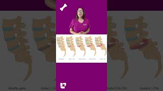 Cathy explains what spondylolisthesis is what causes it and the treatment  LevelUpRN [upl. by Eglantine]