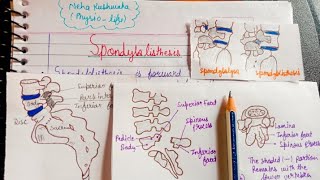 Spondylolisthesis  PathologyTypesDiagnosisTreatment [upl. by Aleuname]