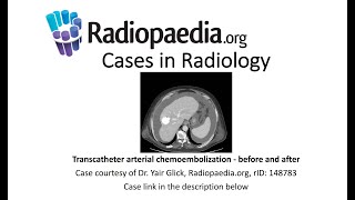 Transcatheter arterial chemoembolization  before and after Radiopaediaorg Cases in Radiology [upl. by Reffinej]