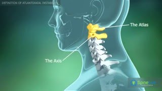 Atlantoaxial instability Definition [upl. by Yslehc]