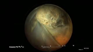 Endoresection of choroidal melanoma subretinal approach through peripheral retinotomy [upl. by Neeneg]