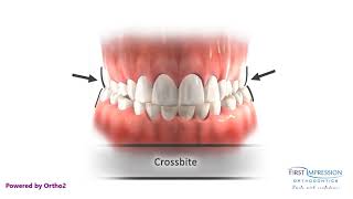 Correcting Posterior Crossbites [upl. by Ynaffet688]