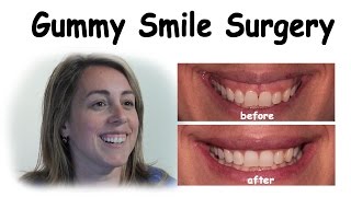 Gummy Smile Surgery  Bergen County NJ Dentist [upl. by Odette158]