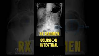 APRENDE A DIAGNOSTICAR OCLUSIÓN INTESTINAL CON RADIOGRAFÍA Oclusion RadiologíaDiagnóstico [upl. by Benni378]