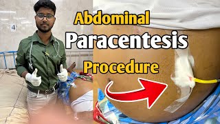 How I do abdominal paracentesis easily during internship after passing FMGE  Abdominal Tap [upl. by Nailuj672]