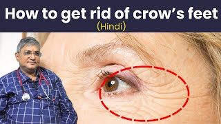 how to get rid of crows feet  crows feet  how to get rid of crows feet and bags under your eyes [upl. by Tse]