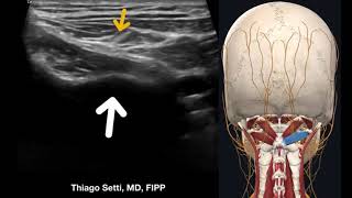 Nervo occipital maior  Nerve occipitalis major [upl. by Delahk826]