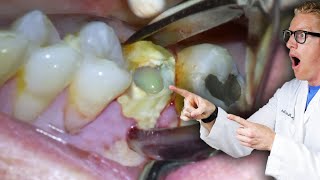 Badly Infected Tooth Extraction Procedure With Pus Coming Out of The Tooth [upl. by Anilejna783]