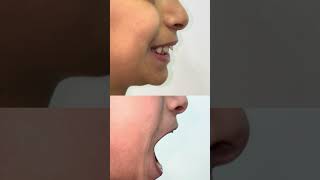 Kids jaw correction children posture correction early orthodontic treatment in the childhood ￼ [upl. by Weiser]