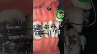 ¡🔥Instalación de microimplante dental en los brackets ANCLAJE ESQUELÉTICO🔥 [upl. by Aohsoj639]