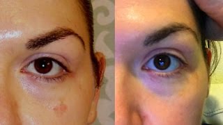 It Works Before and After Hydroquinone [upl. by Penthea691]