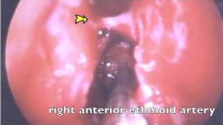 Artery Ligation for Epistaxis [upl. by Atiloj]