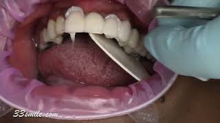 Cosmetic Dentistry Veneer Bridge and Crowns Missing Teeth [upl. by Shanda]