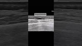 Temporal arteritis ultrasound rheumatology medicine artery cases [upl. by Llehcor]