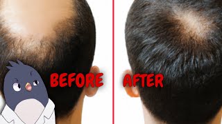 Saw Palmetto Natures Solution for Hair Loss Research Comparing to the Medication Finasteride [upl. by Grindle949]