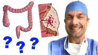 Colorectal Cancer Explained  What You Need to Know [upl. by Atcliffe]