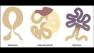 Closed loop obstruction with bowel ischemia  CT findings [upl. by Ottavia453]