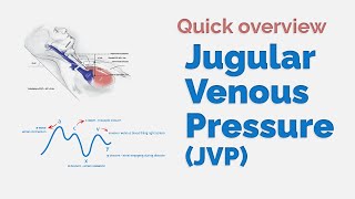 Jugular Venous Pulsations in Constrictive Pericarditis [upl. by Chavez168]