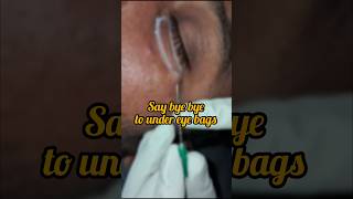 Under eyebags treatment Subcision RF Dermacure rajahmundry eyebagremoval subcision scarless [upl. by Nosnev]