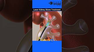 Laser kidney stone treatment  Retrograde Intrarenal Surgery  Rirs  Kidney Stone Treatment shorts [upl. by Garret]