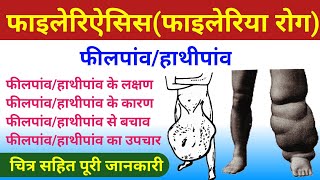 फाइलेरिऐसिस फाइलेरिया रोग  filaria ke lakshan  filariasis  elephantiasis  फीलपांव  हाथीपांव [upl. by Eigger]